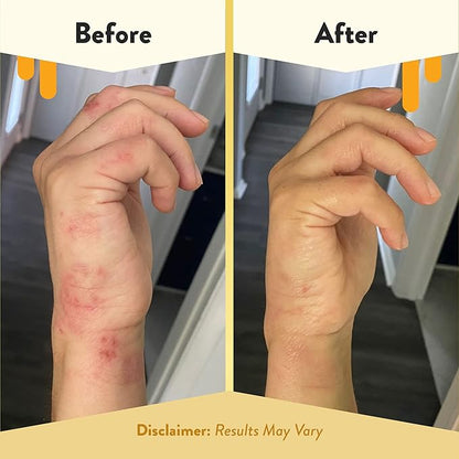 ECZEMA HONEY Antioxidant Body Oil - After Shower All Over Body Oil Spray for Skin - Eczema-Prone & Sensitive Moisturizing Skin Oil - Unscented Body Oils for Women, Men & Kids (8 Fl Oz)